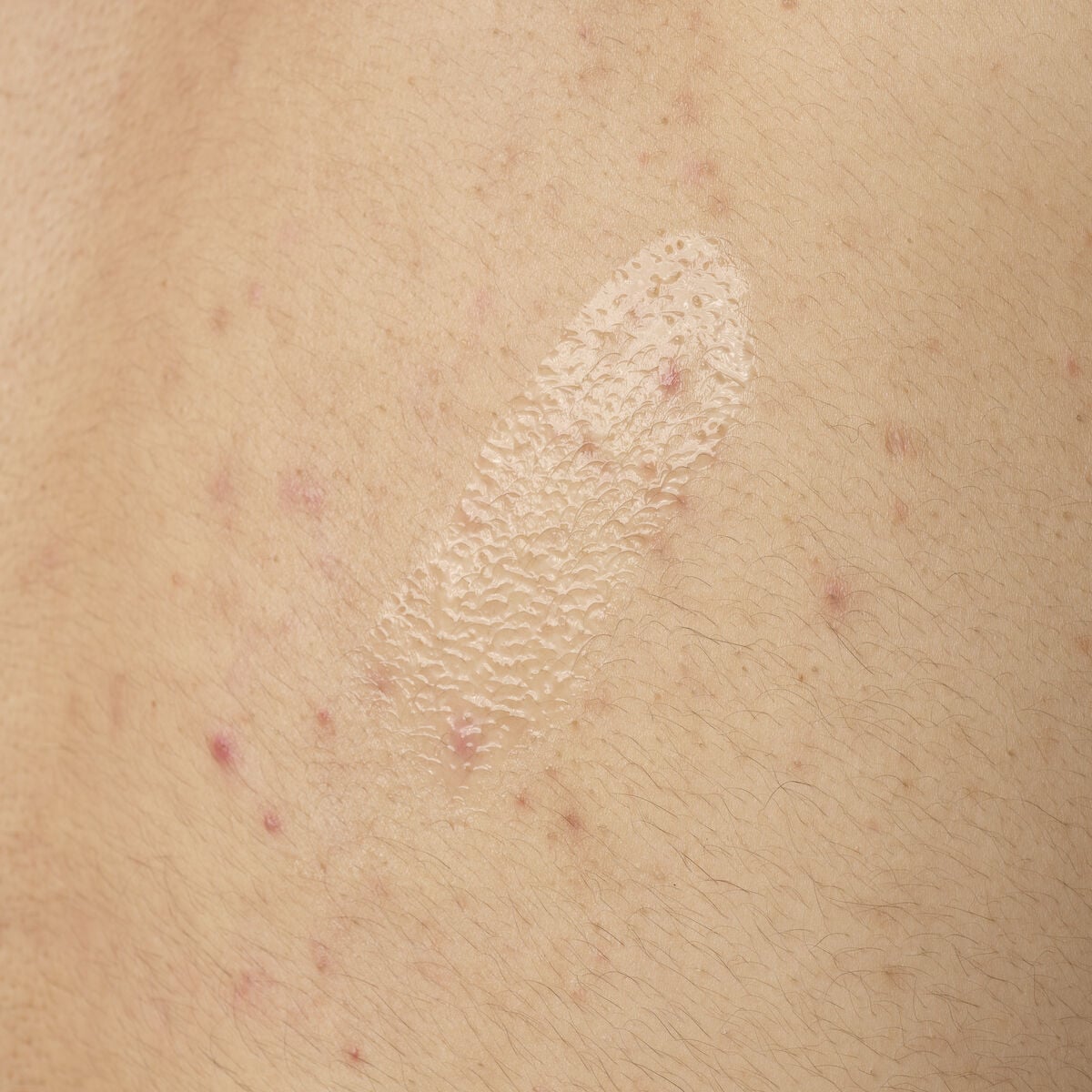 salicylic-acid-0-5-body-serum-b2 ORD-salicylic-acid-05-body-240ml-application.jpg
