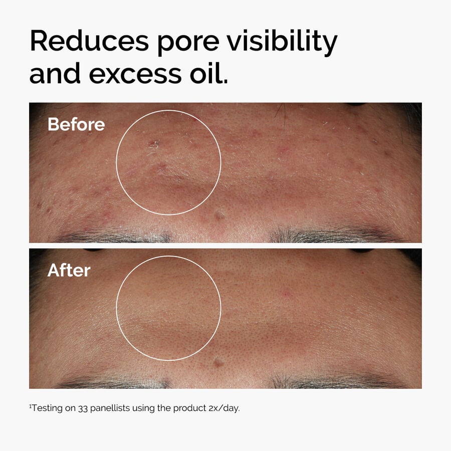 niacinamide-10-zinc-1-f4 ord-niacinamide-zinc-blemish-serum-before-after-pores.jpg