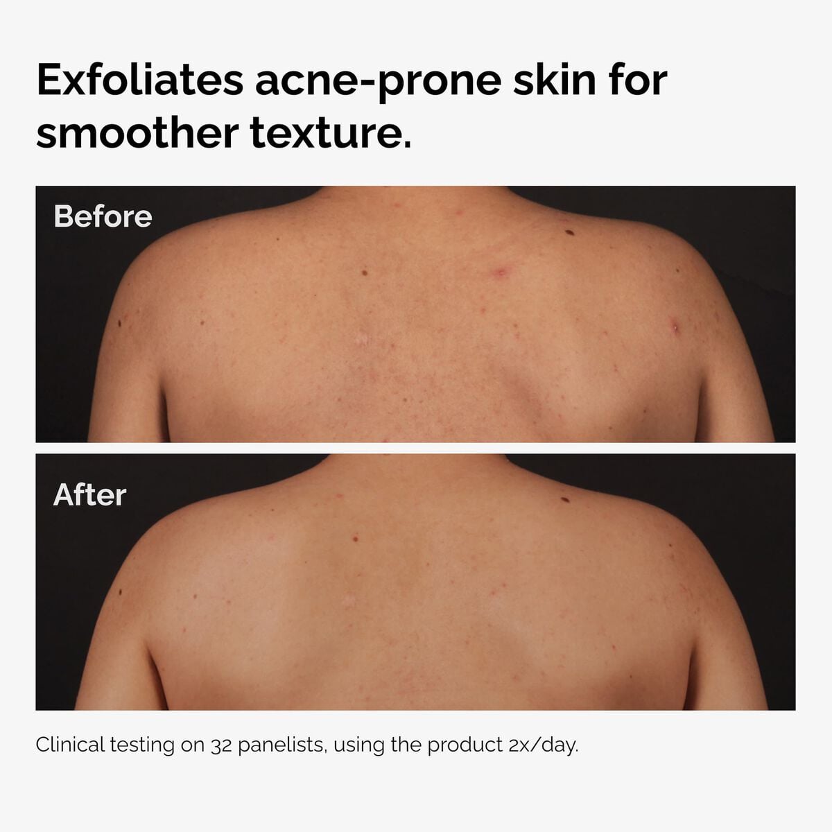 salicylic-acid-0-5-body-serum-b2 ord-salicylic-acid-body-serum-before-after-graphic-NA.jpg